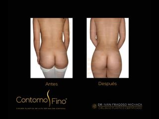 Antes y después de Lipoescultura