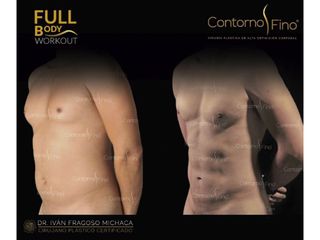 Antes y después de Lipoescultura