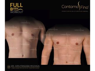 Antes y después de Lipoescultura