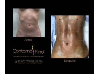 Antes y después de Lipoescultura