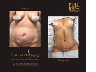Antes y después de Abdominoplastia