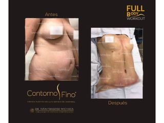 Antes y después de Abdominoplastia