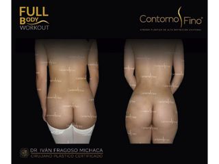 Antes y después de Gluteoplastia