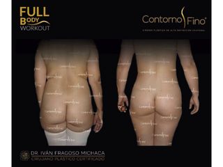 Antes y después de Gluteoplastia
