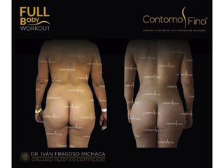 Antes y después de Gluteoplastia