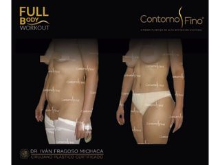 Antes y después de Abdominoplastia