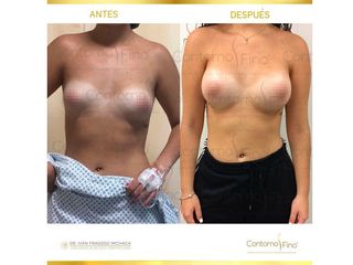 Antes y después de Aumento de busto