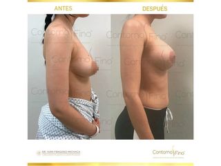 Antes y después de Aumento de busto