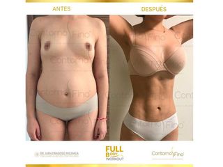 Antes y después de Lipoescultura