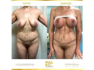 Antes y después de Abdominoplastia