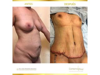 Antes y después de Abdominoplastia