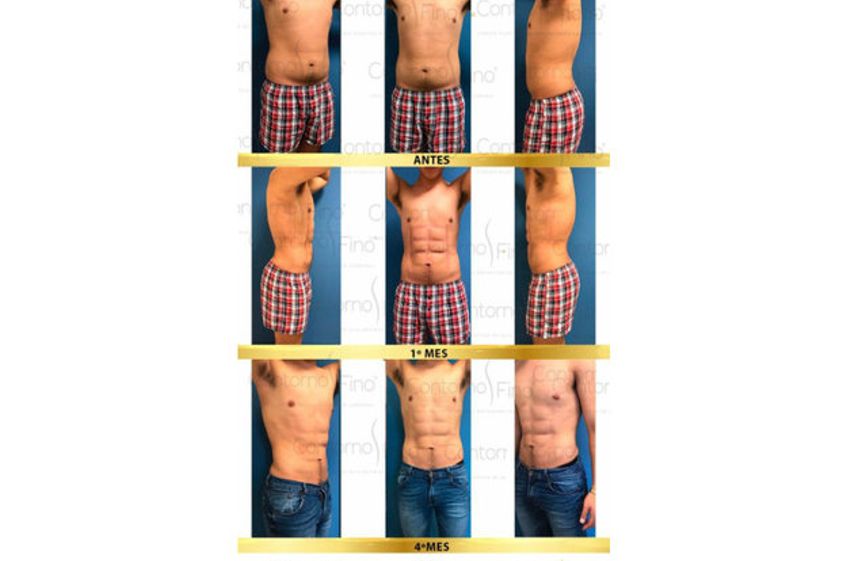 Abdominoplastia antes y después - 626699