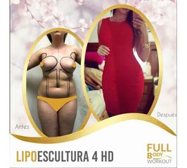 Antes y después de Lipoescultura