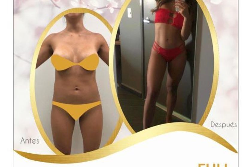 Lipoescultura antes y después - 644177
