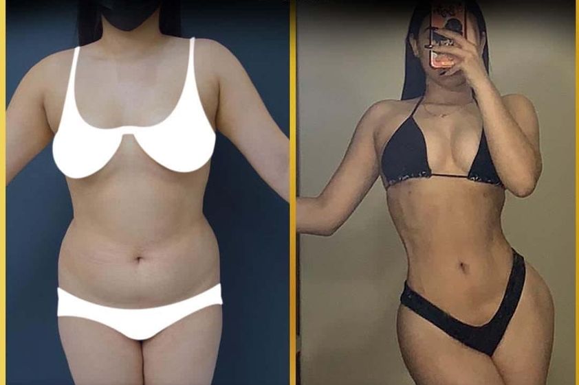 Lipoescultura antes y después - 840041