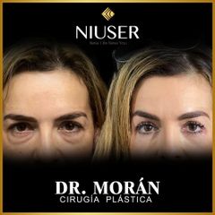 Blefaroplastia - Dr. Jorge Carlos López Morán