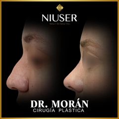 Rinoplastia - Dr. Jorge Carlos López Morán