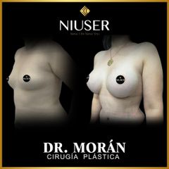 Aumento de busto - Dr. Jorge Carlos López Morán