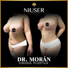 Reducción mamas - Dr. Jorge Carlos López Morán