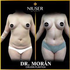 Lipoescultura - Dr. Jorge Carlos López Morán