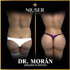 Lipoescultura - Dr. Jorge Carlos López Morán