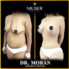 Lipoescultura - Dr. Jorge Carlos López Morán
