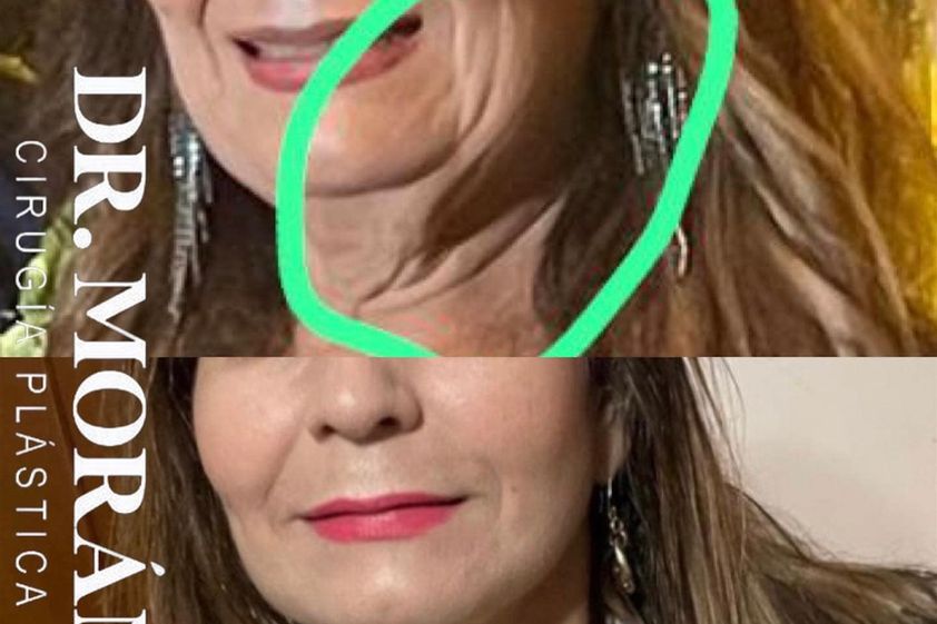 Cirugía facial antes y después - 840054