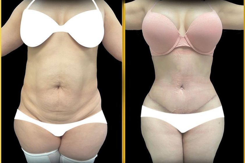 Lipoescultura antes y después - 840055