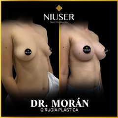 Aumento de busto - Dr. Jorge Carlos López Morán