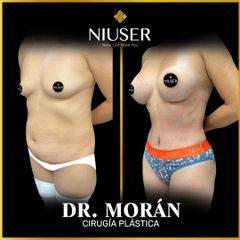 Mommy Makeover - Dr. Jorge Carlos López Morán
