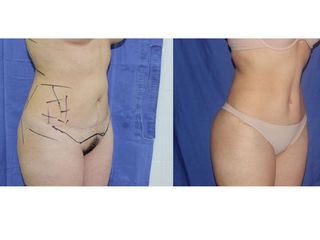 Antes y después de abdominoplastia