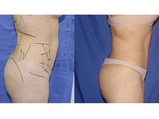 Antes y después de abdominoplastia