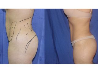 Antes y después de abdominoplastia