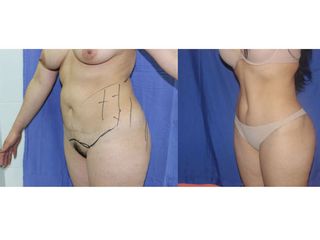 Antes y después de abdominoplastia