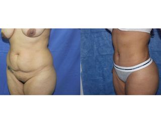 Antes y después de Abdominoplastia