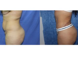 Antes y después de Abdominoplastia