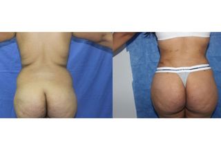 Antes y después de Abdominoplastia