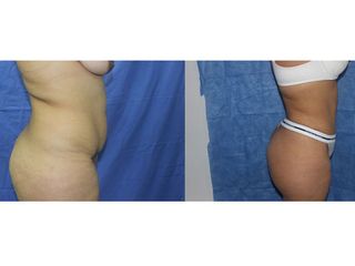 Antes y después de Implantes de Busto 