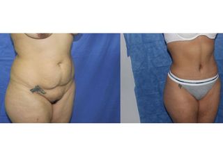 Antes y después de Implantes de Busto 