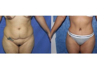 Antes y después de Abdominoplastía