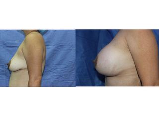 Antes y después de Implantes de Busto 
