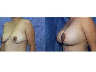 Antes y después de Implantes de Busto 