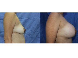 Antes y después de Implantes de Busto 