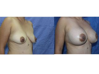 Antes y después de Implantes de Busto 