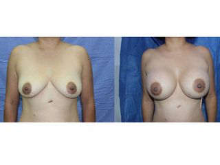 Antes y después de Implantes de Busto 