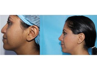 Rinoplastia Antes y después de una Rinoplastia