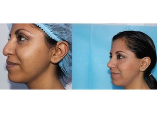 Antes y después de una Rinoplastia