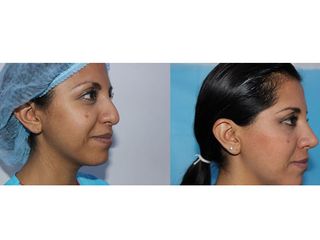 Antes y después de una Rinoplastia