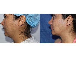 Antes y después de Rinoplastia 