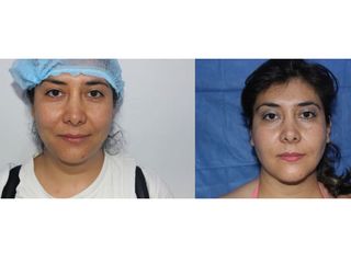 Antes y después de Rinoplastia 